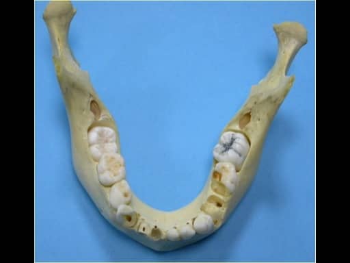 Dissection chirurgie maxillaire